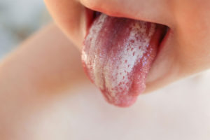 oral thrush (yeast) on baby's tongue breastfeeding
